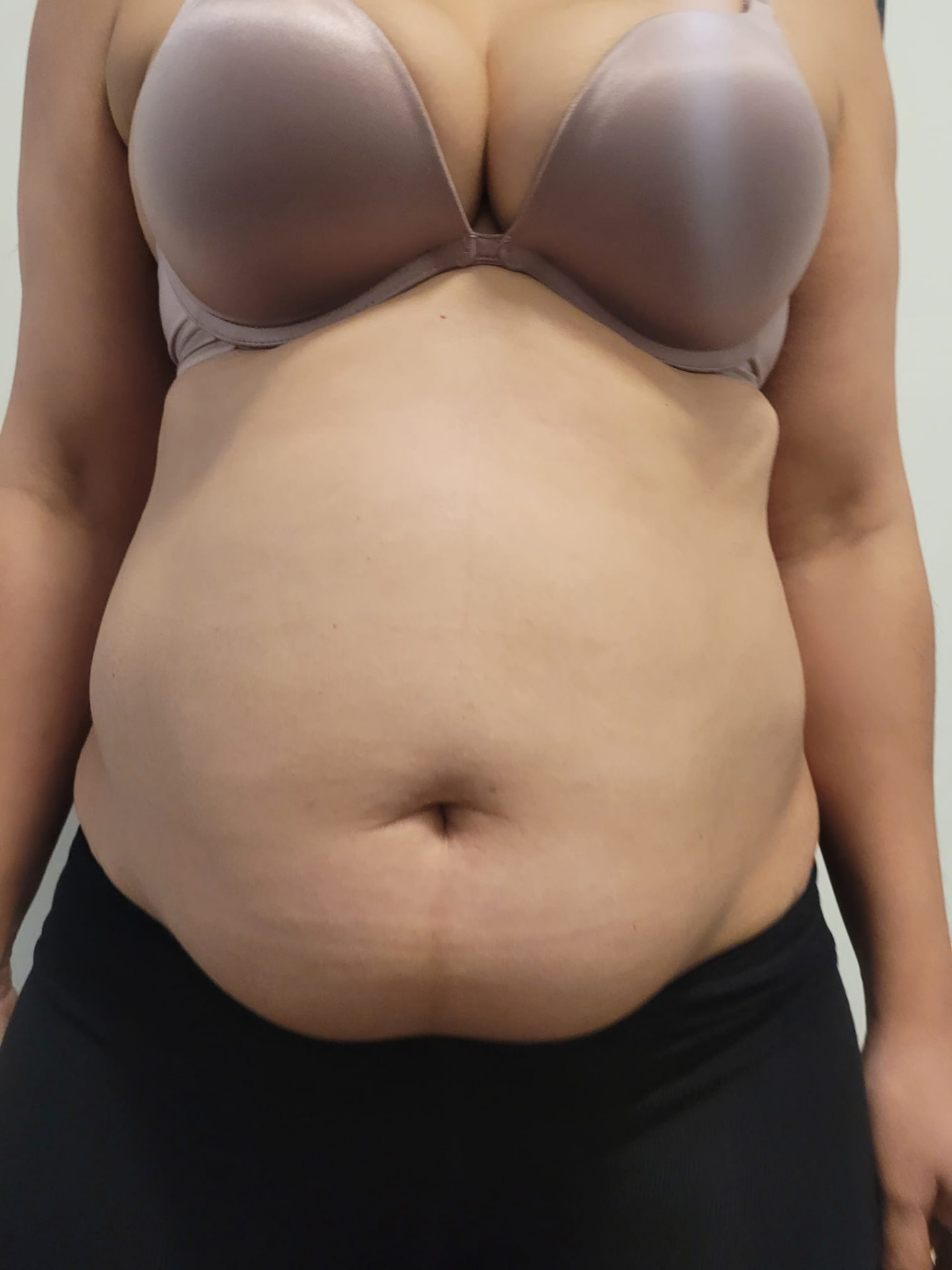 Voor de behandeling: Cryolipolyse 360° + EMS+ — Buik