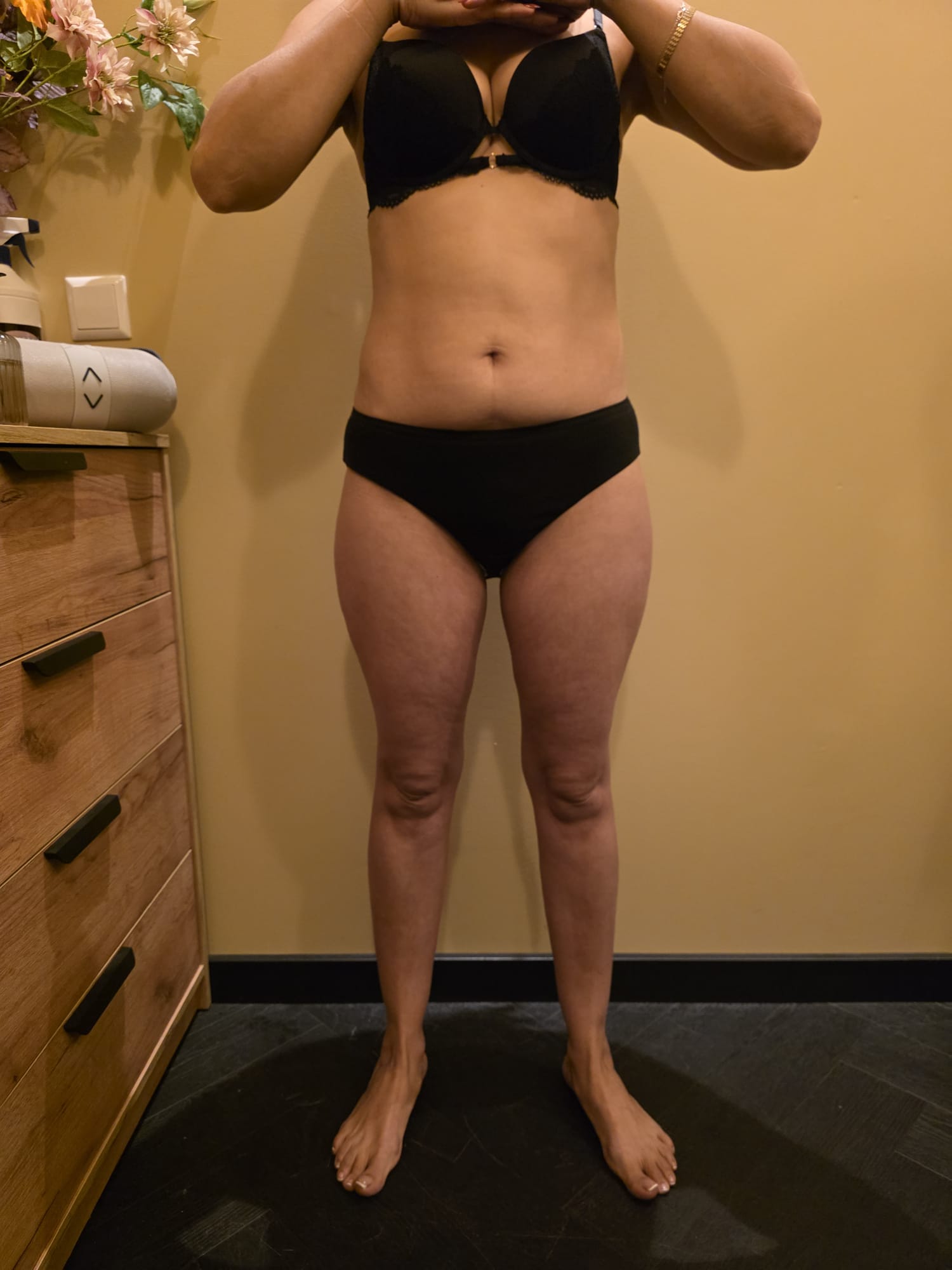 Na de behandeling: Cryolipolyse 360° + EMS+ — Buik